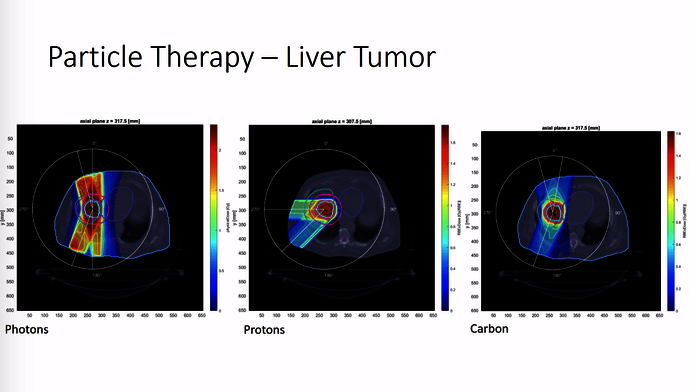 Simulation of liver treatment produced with software MatRad.